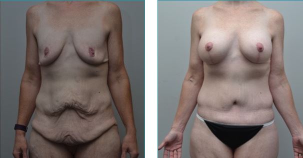 Tummy tuck before-and-after photos