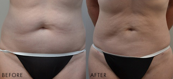 Before and after liposuction