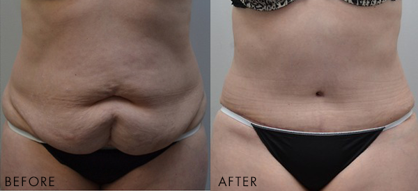 Before and after tummy tuck and liposuction