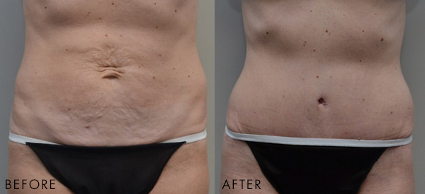 Before and after tummy tuck