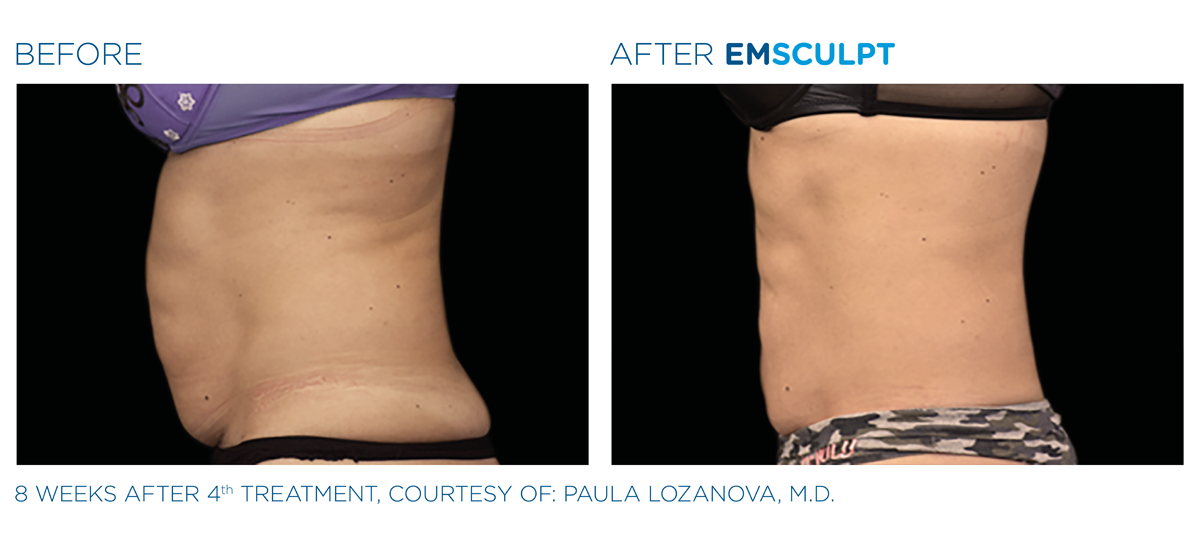 Side view of patient\'s tummy before EMSCULPT and her flatter, more toned tummy after 4 treatments.