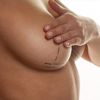 Model covering breasts with surgery marker markings