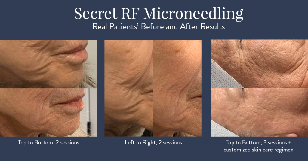 Secret RF Microneedling results at Rockmore Plastic Surgery.