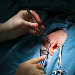 Close up of a surgeon performing an earlobe surgery.