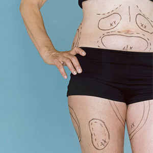 Torso and upper leg shot of a woman with surgical black ink markings on her tummy, flanks, and thighs.