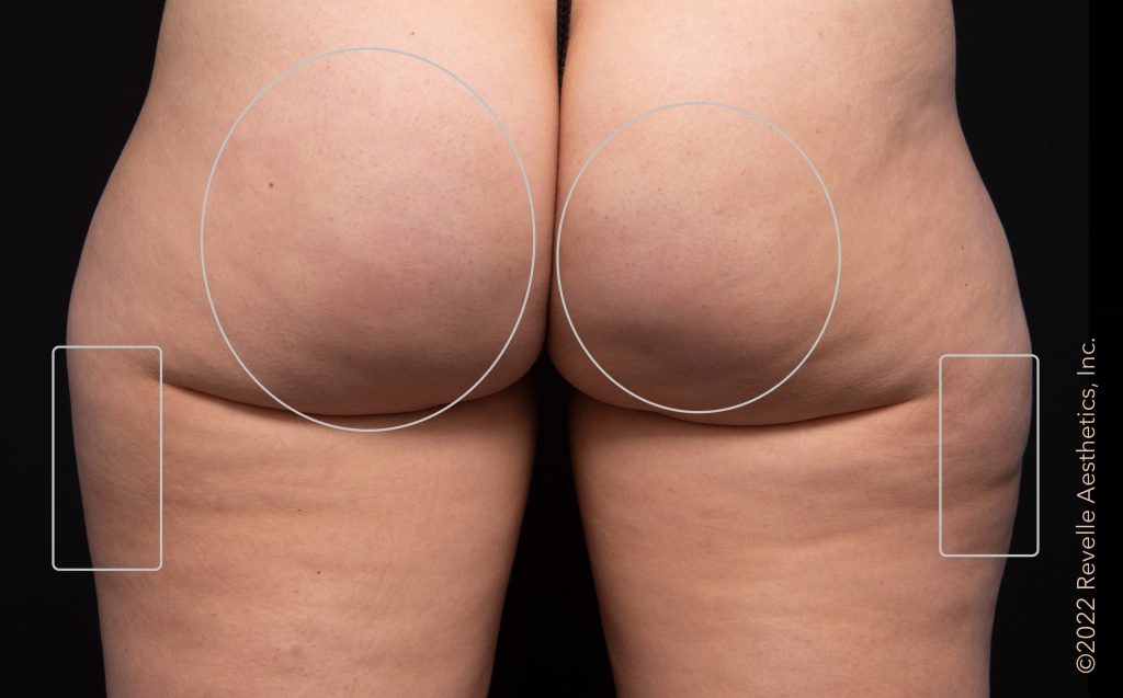 after Aveli cellulite treatment