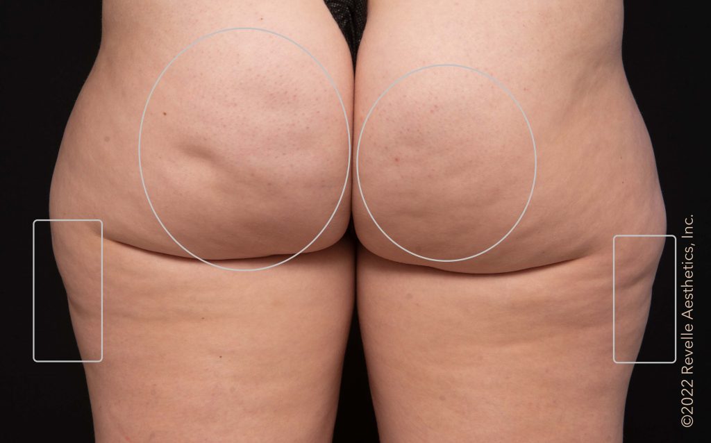 before Aveli cellulite treatment