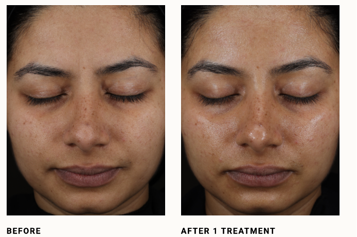 Before and After DiamondGlow Facial Manufacturer Image