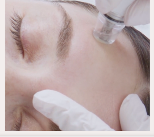 DiamondGlow Facial In Progress (Manufacturer Image)