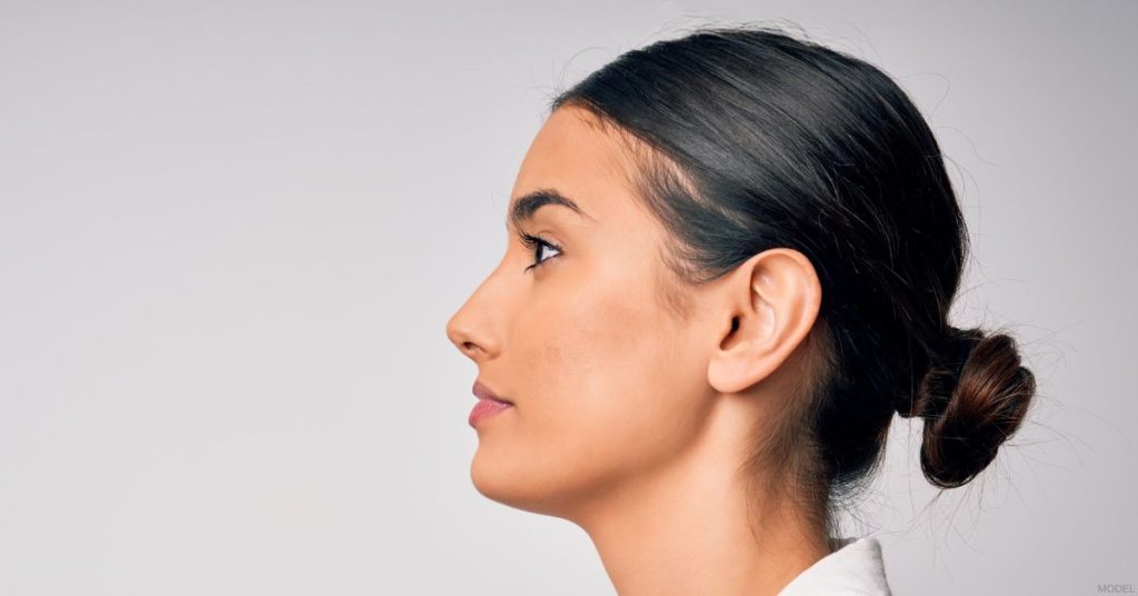 Woman after rhinoplasty procedure. (Model)